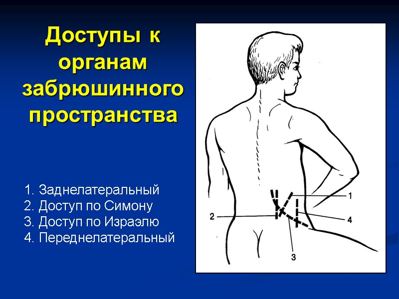 Доступы к органам  забрюшинного пространства Заднелатеральный Доступ по Симону Доступ по Израэлю Переднелатеральный